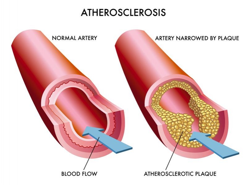 Tyagi-ecp-atherosclerosis