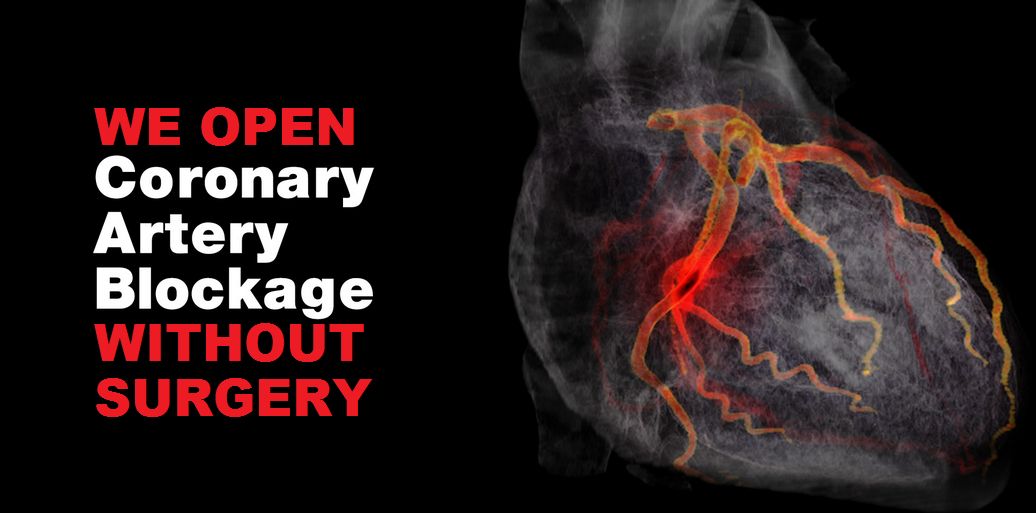 Tyagi-ECP-artery-blockage